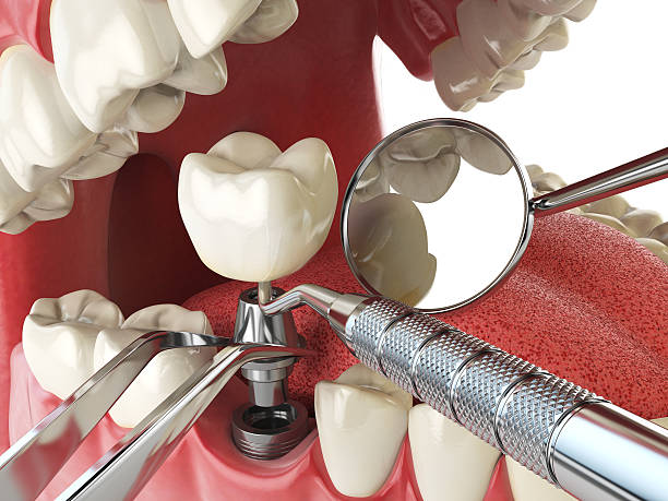 Best Same-Day Emergency Dentist in Canterwood, WA